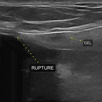 breast implant ultrasound in Dallas TX