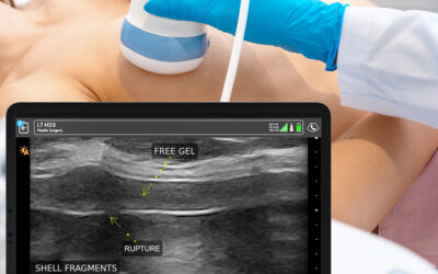 Have Silicone Breast Implants? Schedule an Ultrasound to Screen for a “Silent Rupture” Today